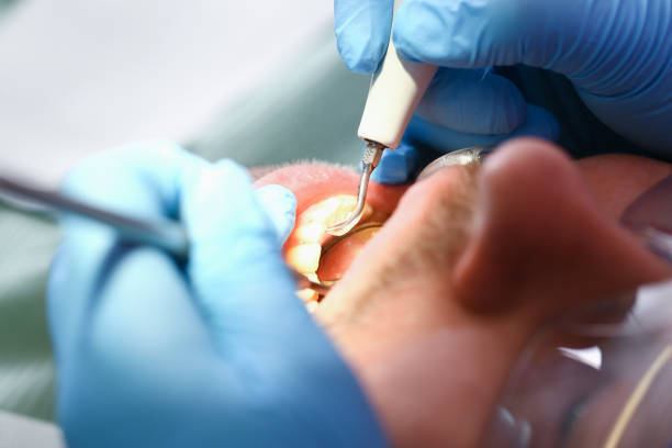 Best Urgent Care for Lost Fillings or Crowns in Corte Madera, CA