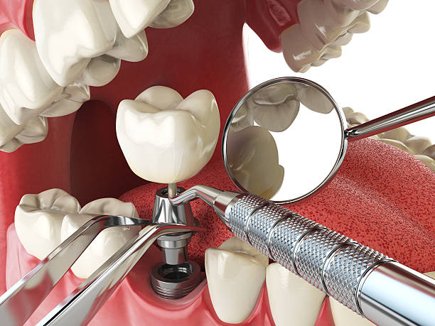 Best Emergency Tooth Extraction in Corte Madera, CA