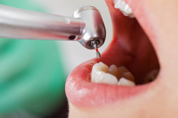 Best Emergency Dental Care for Broken or Chipped Teeth in Corte Madera, CA